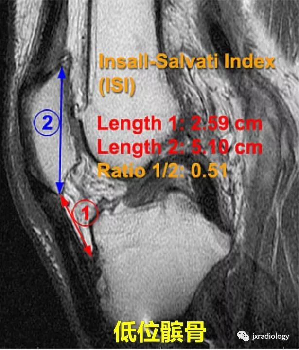 高位/低位髌骨(Patella Alta and Baja) 高位/低位髌骨(Patella Alta and Baja)