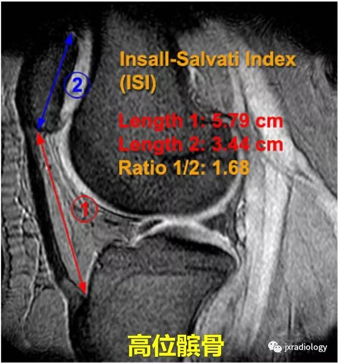 高位/低位髌骨(Patella Alta and Baja) 高位/低位髌骨(Patella Alta and Baja)
