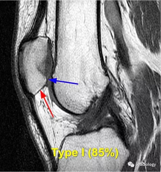 高位/低位髌骨(Patella Alta and Baja) 高位/低位髌骨(Patella Alta and Baja)