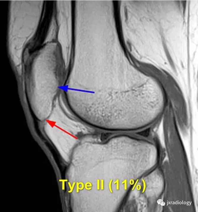 高位/低位髌骨(Patella Alta and Baja) 高位/低位髌骨(Patella Alta and Baja)