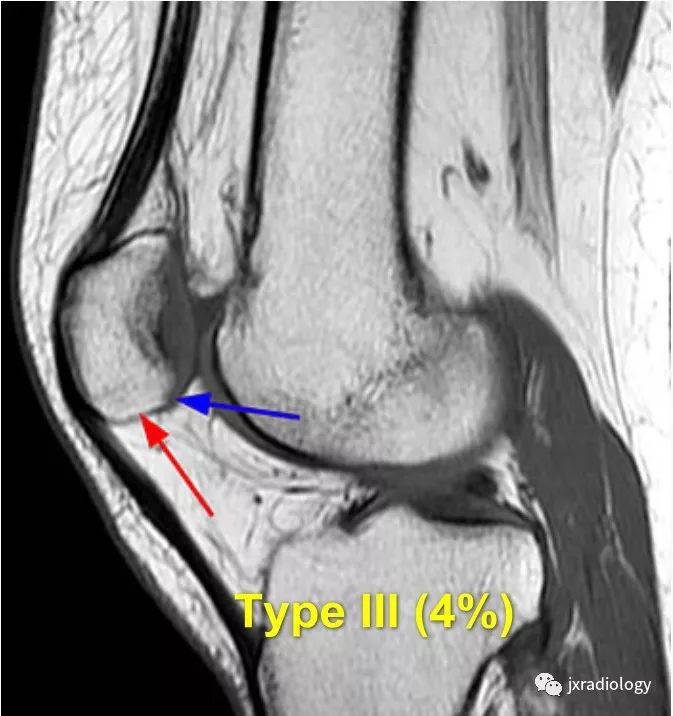 高位/低位髌骨(Patella Alta and Baja) 高位/低位髌骨(Patella Alta and Baja)