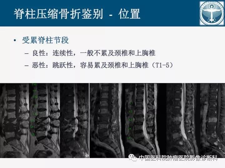 【PPT】椎体压缩骨折MRI鉴别诊断
