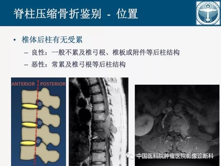 【PPT】椎体压缩骨折MRI鉴别诊断