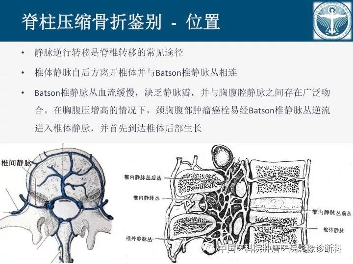【PPT】椎体压缩骨折MRI鉴别诊断