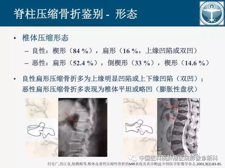 【PPT】椎体压缩骨折MRI鉴别诊断