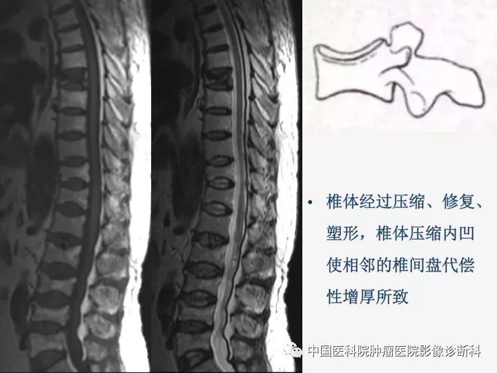 【PPT】椎体压缩骨折MRI鉴别诊断