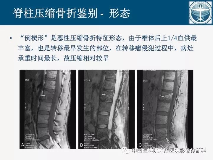 【PPT】椎体压缩骨折MRI鉴别诊断