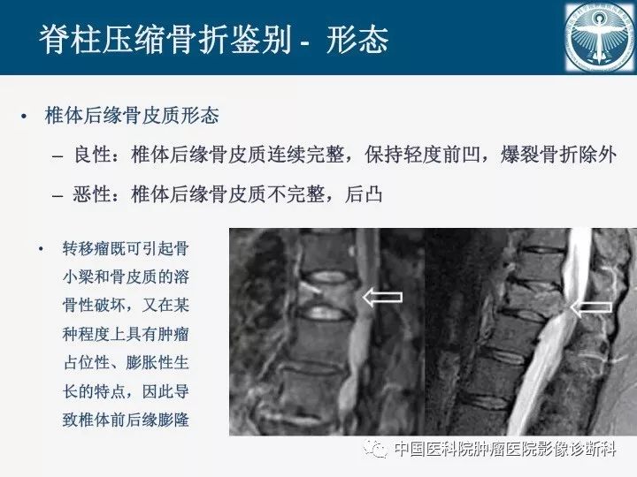 【PPT】椎体压缩骨折MRI鉴别诊断