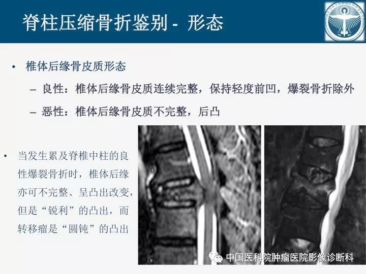 【PPT】椎体压缩骨折MRI鉴别诊断