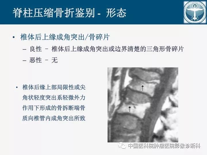 【PPT】椎体压缩骨折MRI鉴别诊断