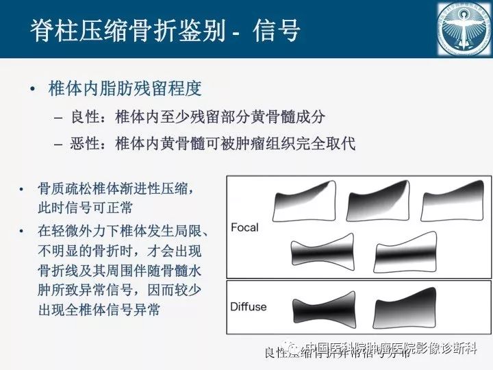 【PPT】椎体压缩骨折MRI鉴别诊断