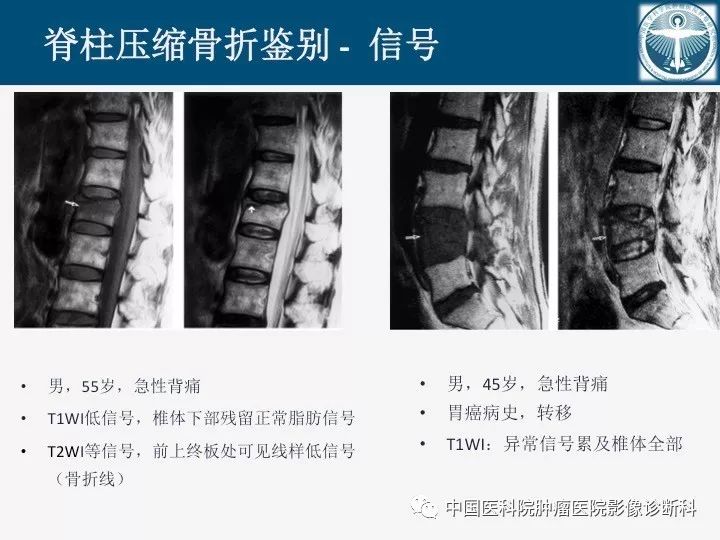 【PPT】椎体压缩骨折MRI鉴别诊断