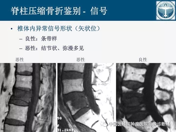 【PPT】椎体压缩骨折MRI鉴别诊断