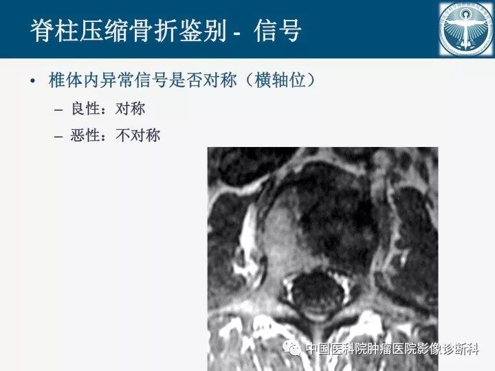 【PPT】椎体压缩骨折MRI鉴别诊断