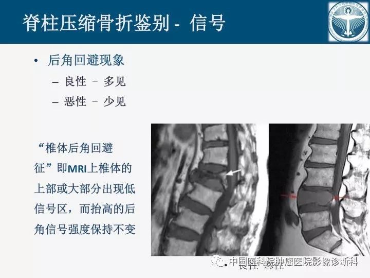 【PPT】椎体压缩骨折MRI鉴别诊断
