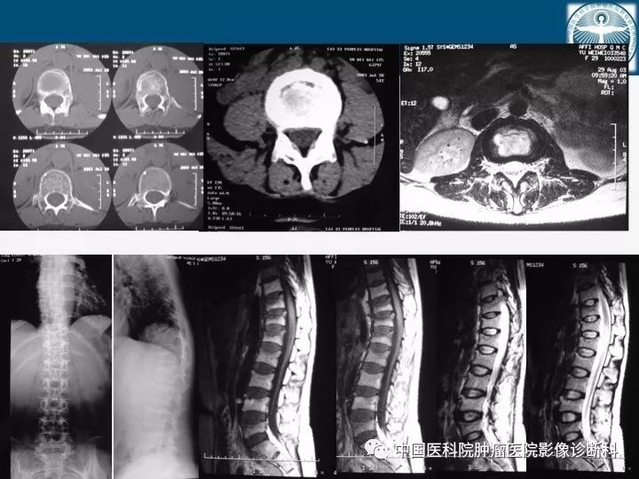 【PPT】椎体压缩骨折MRI鉴别诊断