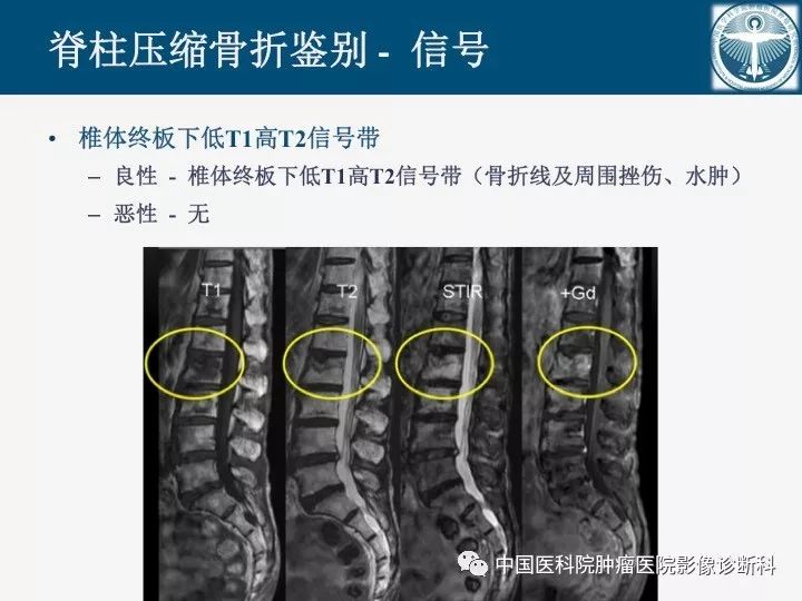【PPT】椎体压缩骨折MRI鉴别诊断