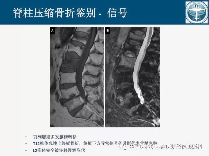 【PPT】椎体压缩骨折MRI鉴别诊断