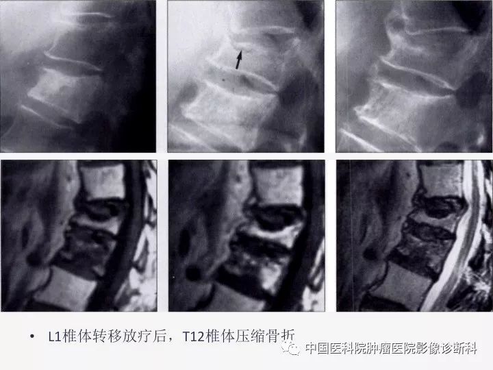 【PPT】椎体压缩骨折MRI鉴别诊断