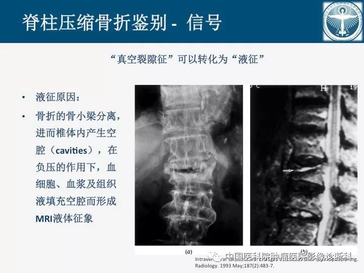 【PPT】椎体压缩骨折MRI鉴别诊断