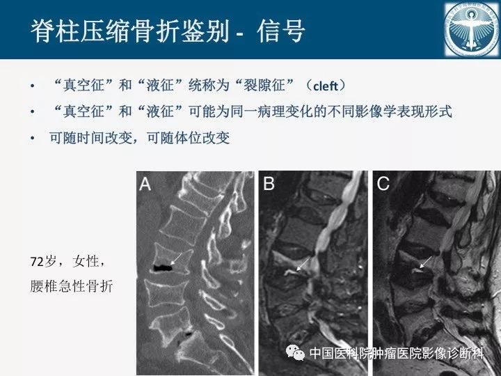 【PPT】椎体压缩骨折MRI鉴别诊断