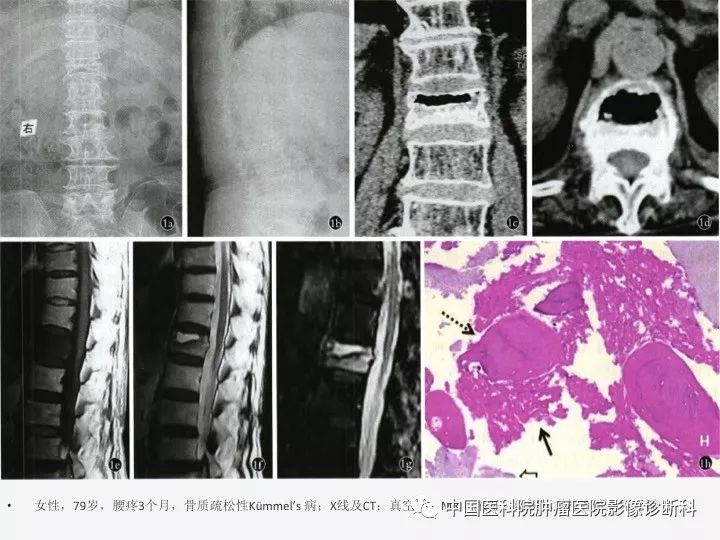 【PPT】椎体压缩骨折MRI鉴别诊断