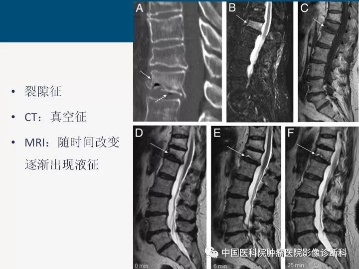 【PPT】椎体压缩骨折MRI鉴别诊断