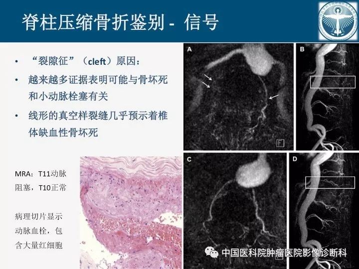 【PPT】椎体压缩骨折MRI鉴别诊断