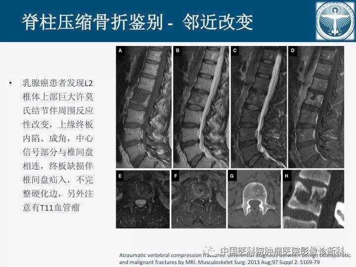【PPT】椎体压缩骨折MRI鉴别诊断
