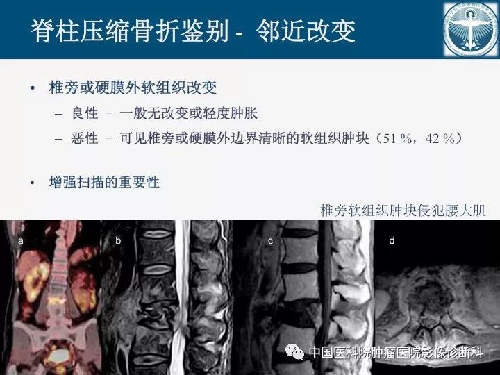 【PPT】椎体压缩骨折MRI鉴别诊断