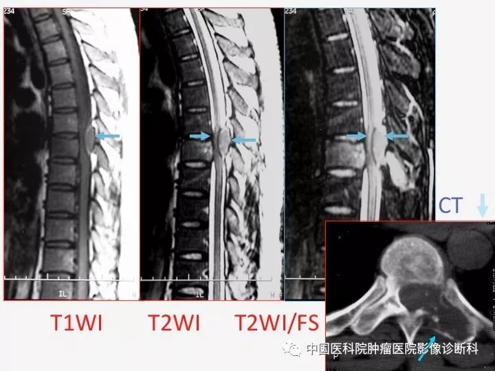 【PPT】椎体压缩骨折MRI鉴别诊断