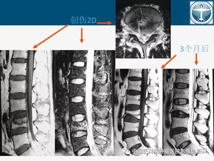 【PPT】椎体压缩骨折MRI鉴别诊断