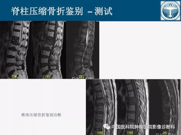 【PPT】椎体压缩骨折MRI鉴别诊断