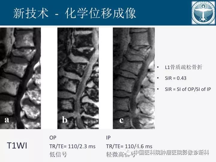 【PPT】椎体压缩骨折MRI鉴别诊断
