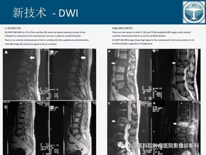 【PPT】椎体压缩骨折MRI鉴别诊断