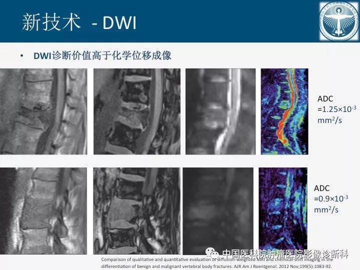 【PPT】椎体压缩骨折MRI鉴别诊断