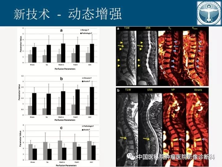 【PPT】椎体压缩骨折MRI鉴别诊断