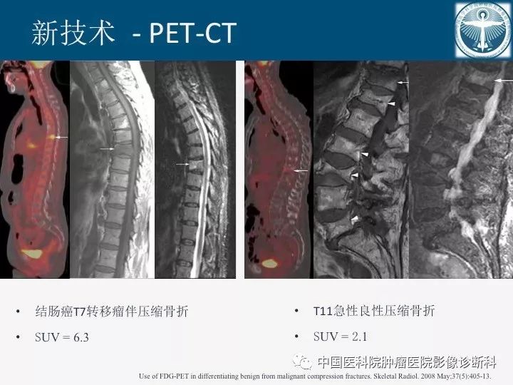 【PPT】椎体压缩骨折MRI鉴别诊断