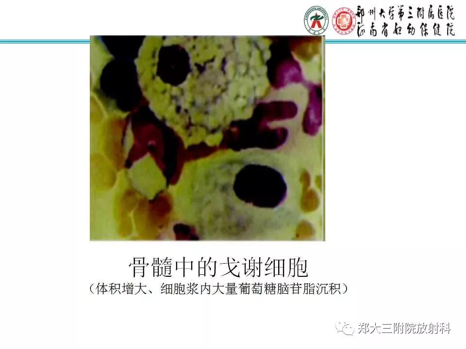 【PPT】戈谢病的影像