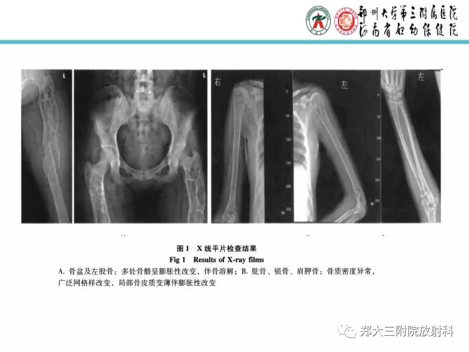【PPT】戈谢病的影像