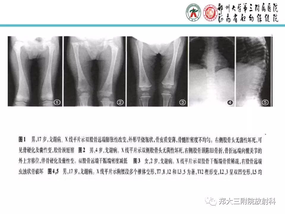 【PPT】戈谢病的影像