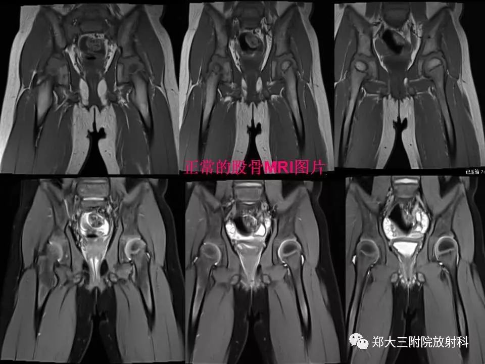 【PPT】戈谢病的影像