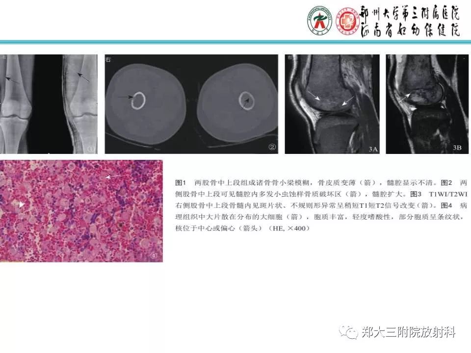 【PPT】戈谢病的影像