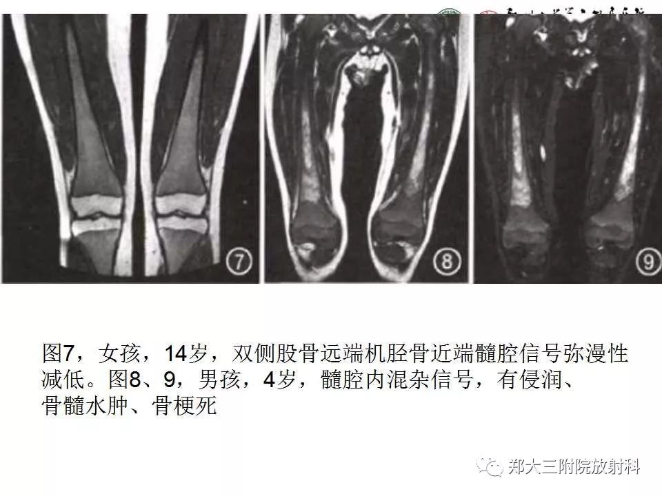 【PPT】戈谢病的影像