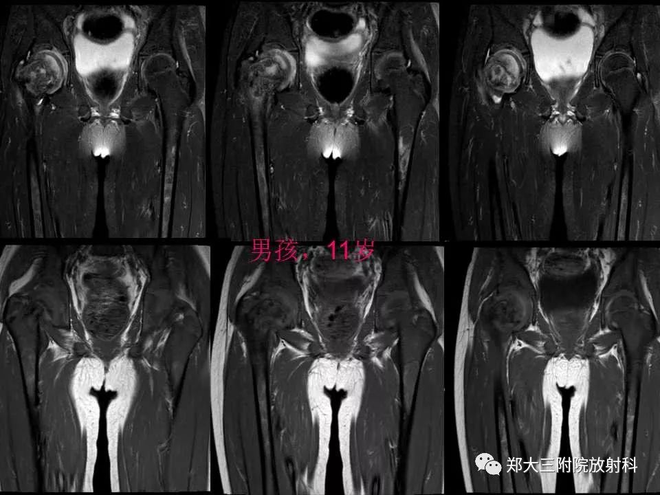 【PPT】戈谢病的影像
