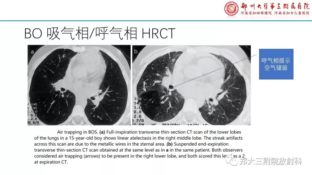 【PPT】闭塞性毛细支气管炎的影像诊断