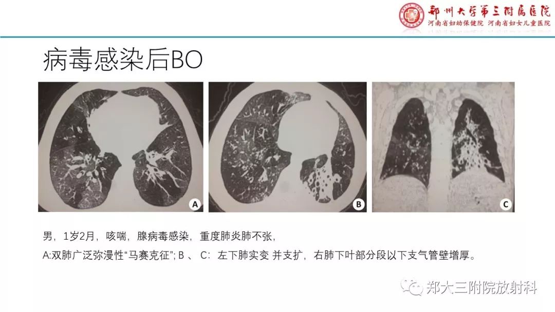 【PPT】闭塞性毛细支气管炎的影像诊断