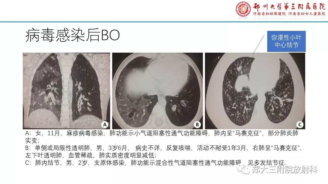 【PPT】闭塞性毛细支气管炎的影像诊断