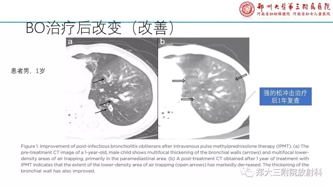 【PPT】闭塞性毛细支气管炎的影像诊断