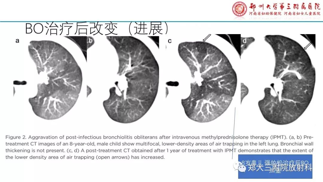 【PPT】闭塞性毛细支气管炎的影像诊断